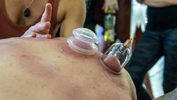 Image of modern cupping therapy technique